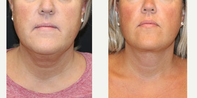 before and after image