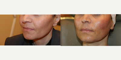 Sculptra before and after photo