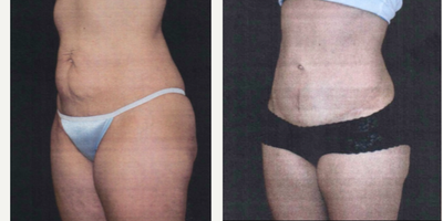 Tummy Tuck before and after photo