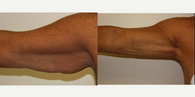 Arm Lift before and after photo