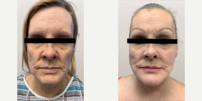 Facelift before and after photo