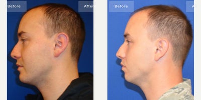 Facial Reconstructive Surgery before and after photo