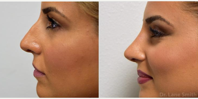 Rhinoplasty before and after photo