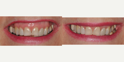 Botox for Gummy Smile before and after photo
