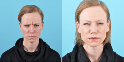Botox before and after photo