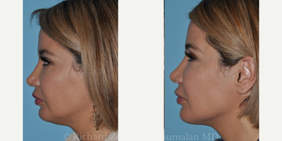 Chin Liposuction before and after photo