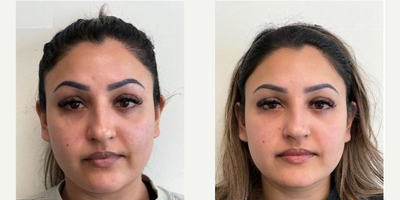 Dermal Fillers before and after photo