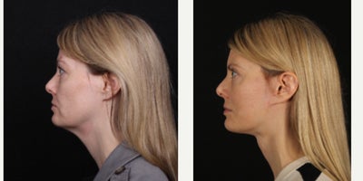 Facelift before and after photo
