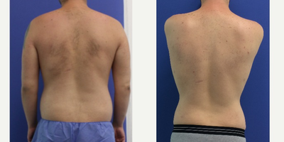 Liposculpture before and after photo