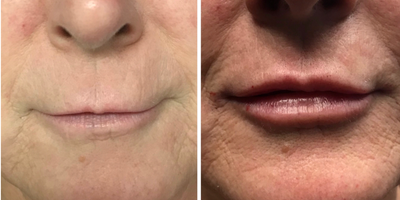 Restylane before and after photo