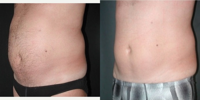 UltraShape before and after photo