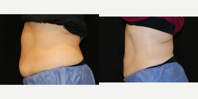 CoolSculpting before and after photo