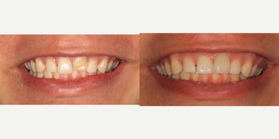 Dental Bonding before and after photo