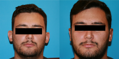 Ear Surgery before and after photo
