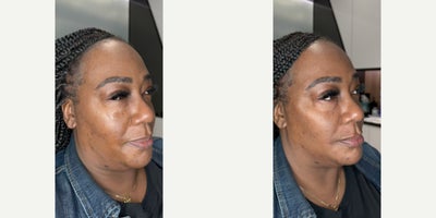 Lip Fillers before and after photo