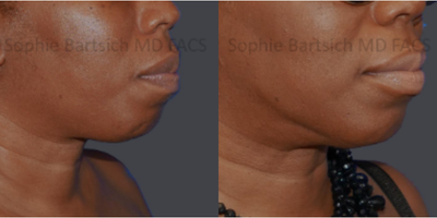 Liposuction before and after photo