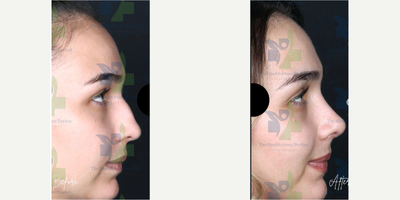 Rhinoplasty before and after photo