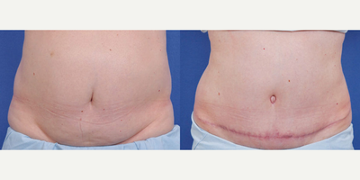 Tummy Tuck before and after photo