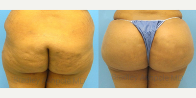 Brazilian Butt Lift before and after photo