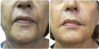 Dermal Fillers before and after photo