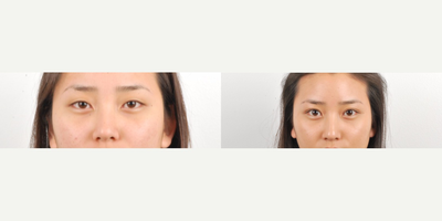 Double Eyelid Surgery before and after photo