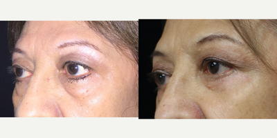 Eyelid Surgery before and after photo