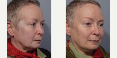 Eyelid Surgery before and after photo