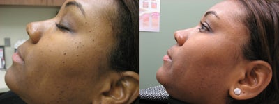 Mole Removal before and after photo