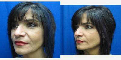 Radiesse before and after photo