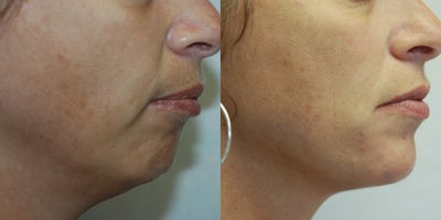 Facelift before and after photo