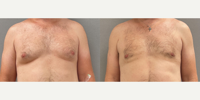 Gynecomastia Surgery before and after photo