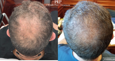 PRP for Hair Loss before and after photo