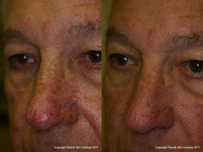 Sclerotherapy before and after photo