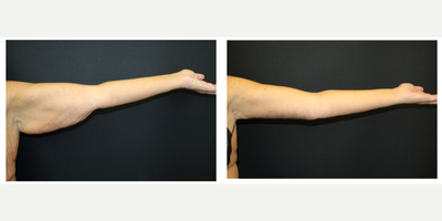 Arm Lift before and after photo