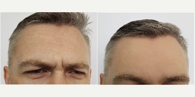 Botox before and after photo