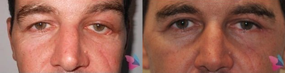 Eyelid Surgery before and after photo