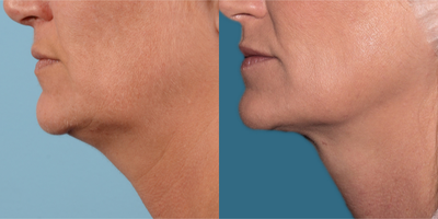 FaceTite before and after photo