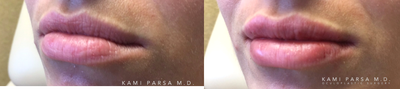 Lip Fillers before and after photo