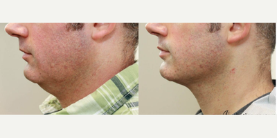 Nonsurgical Neck Lift before and after photo
