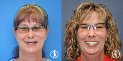 Dental Implants before and after photo