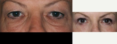Eyelid Surgery before and after photo