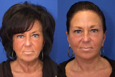 Facelift before and after photo