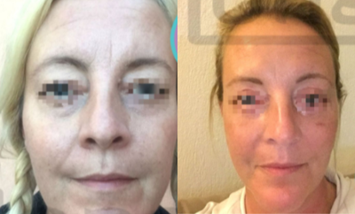 Facelift before and after photo
