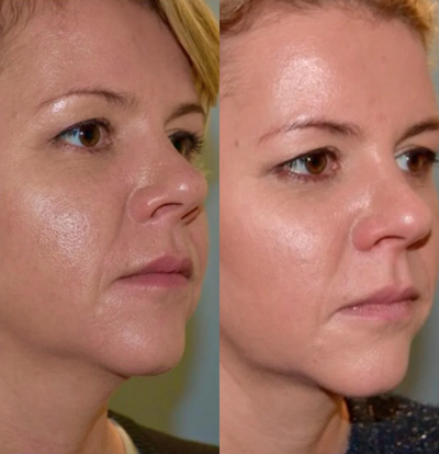 Kybella before and after photo