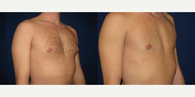 Breast Reduction before and after photo