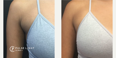 CoolSculpting before and after photo