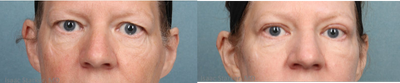 Eyelid Surgery before and after photo