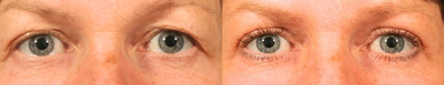 Eyelid Surgery before and after photo