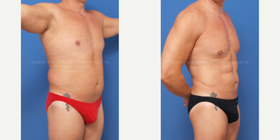 Liposculpture before and after photo