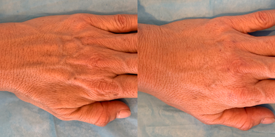 Restylane Lyft before and after photo